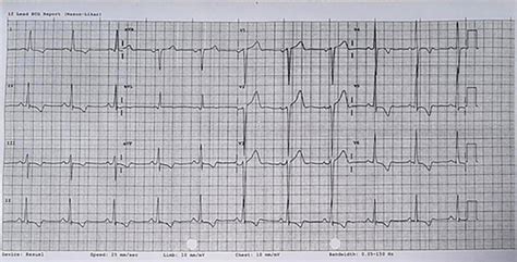 ejektion fraktion ekg.